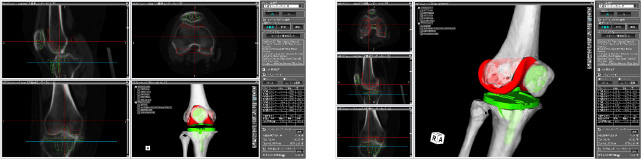 人工膝関節手術の3次元コンピュータシミュレーション